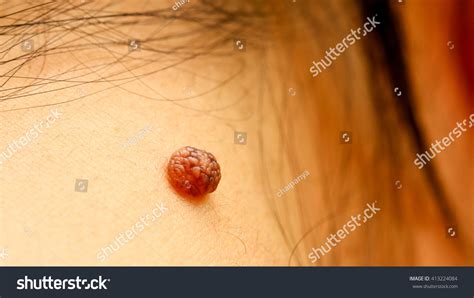 Birthmark On Skin Mole Closeup Stock Photo 413224084 Shutterstock
