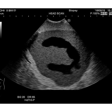 Ultrasound Neonatal Head Phantom Abnormal Type Kyoto Kagaku