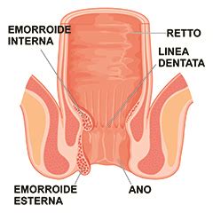 Emorroidi Sintomi Cause E Prevenzione Issalute