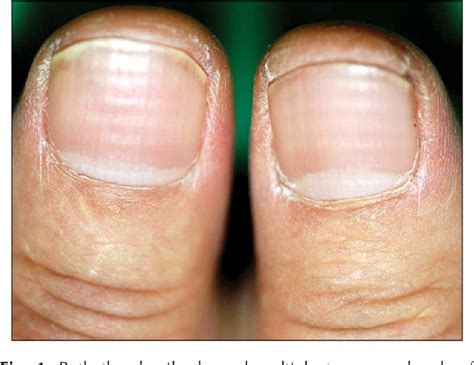 Figure 1 From Nail Change After Chemotherapy Simultaneous Development