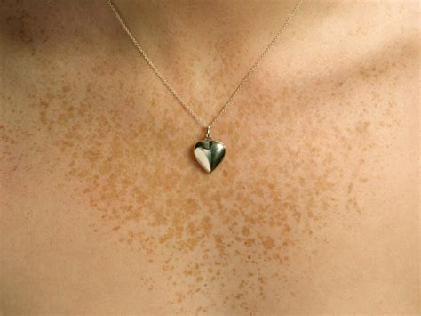 Chest Freckles Led One Woman To Discover She Had A Rare Form Of Breast