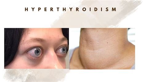 5 Signs And Symptoms Of Hyperthyroidism How To Manage Jayyush Hospital