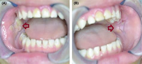 Which Part Of Teeth Is Used For Biting And Cutting Caridad Dentons