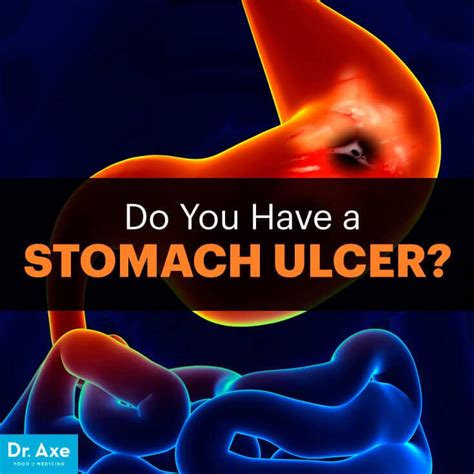 Keep reading this momjunction post to learn about the symptoms, causes, treatment, and prevention of mouth. Stomach Ulcer Symptoms & How to Treat Them - Dr. Axe