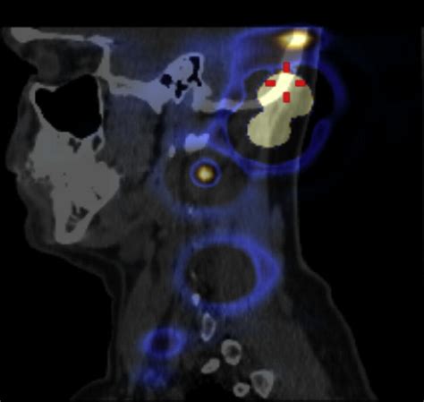 The Role Of Hybrid Spectct For Lymphatic Mapping In Patients With