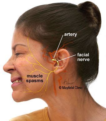 Facial Twitch Or Hemifacial Spasm Hfs Is An Involuntary Twitching Or