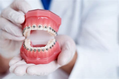 The Truth Behind Dental Braces Myths And Facts Unveiled Bella Dental