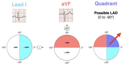 Ecg Axis Interpretation Litfl Ecg Library Basics