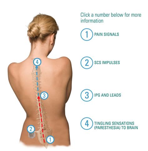 Boston Scientific Releases Spinal Cord Stimulator Trial App Imedicalapps