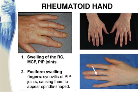 Ppt Rheumatoid Arthritis Ra Powerpoint Presentation Free Download