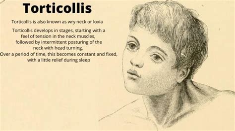 Comprehensive Guide To Torticollis Symptoms Causes Treatment