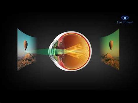 Cataract Overview Eye Patient