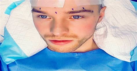 X Factor Star Lloyd Daniels Undergoes Hair Transplant After Bravely