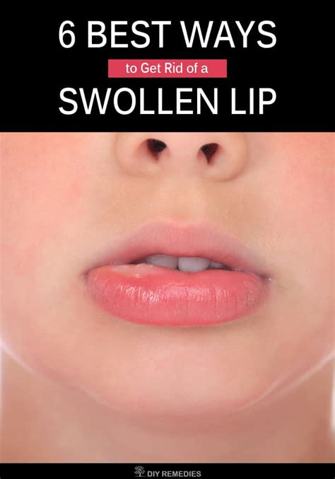 6 Best Ways To Get Rid Of A Swollen Lip