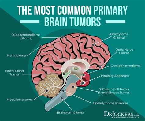 Causes For Brain Cancer Brainlyvh