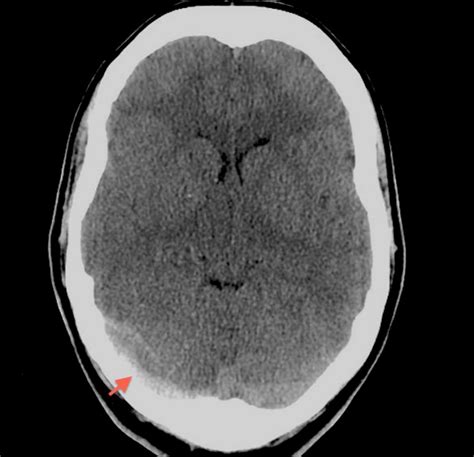 Dural Sinus Thrombosis And Venous Infarction Radiology Case