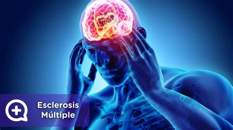 La esclerosis múltiple es una enfermedad que empeora con el tiempo (degenerativa) que afecta el sistema nervioso central (el cerebro y la médula espinal) caracterizada por destrucción de la mielina (que es el tejido graso que protege las fibras nerviosas y promueve la transmisión de los impulsos nerviosos) y por el daño a las células nerviosas. Esclerosis Múltiple: diagnóstico, síntomas y tratamiento ...