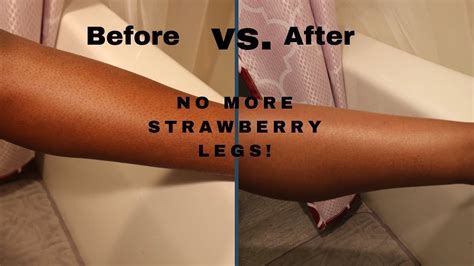 How To Get Rid Of Strawberry Skin Permanently Buy Now Link In