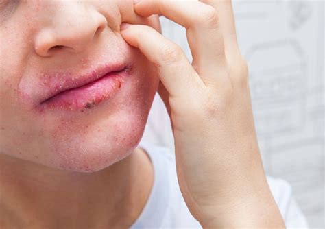 Eczema On Lips Symptoms Triggers Home Remedies And Treatments