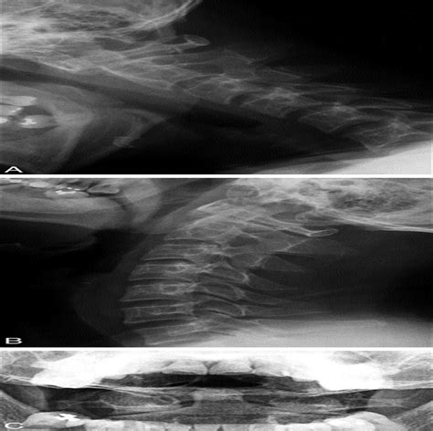 Post Traumatic Atlantoaxial Rotatory Fixation In An Adult A Spine