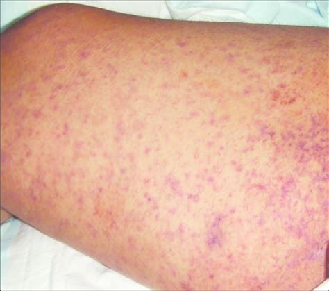 Lupus Petechiae Rash