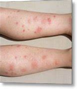 Allergic Reaction To Mosquito Bites By David Parker Science Photo Library