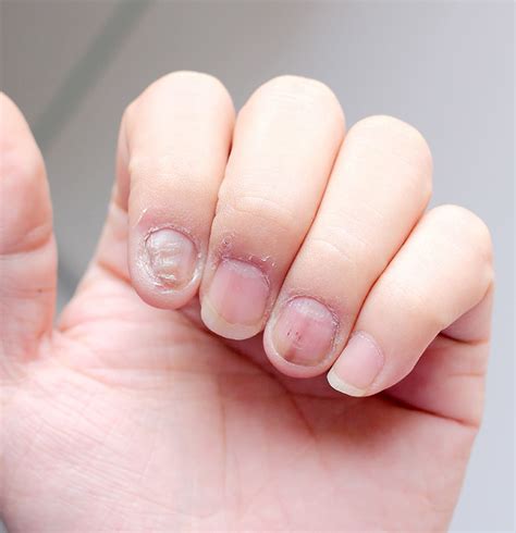 Nail Fungal Treatment In Singapore Dr Noor Hanif Said