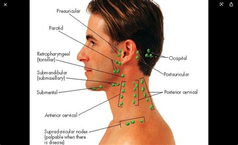 Headache Swollen Lymph Nodes Neck Pain Information Aboutheadache