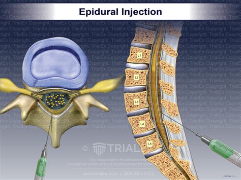 Epidural Injection Trial Exhibits Inc