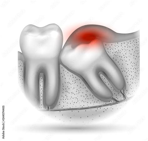 Wisdom Tooth Eruption Problems Inflamed Gums Illustrated Anatomy Stock