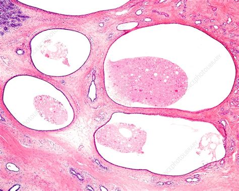 Fibrocystic Breast Change Light Micrograph Stock Image C0510104