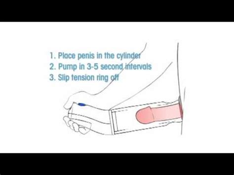 Erectile Dysfunction Penile Prosthesis Port Macquarie Australia Youtube