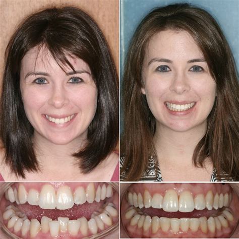 Amazing Invisalign Results In 10 Months Dr Ginger Price Elite