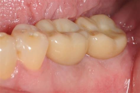 Two Molars Dental Implants Two Molars Dental Implants Kazemi Oral