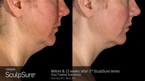 Submental Contouring With Sculpsure® Whittier Ca Vita Aesthetics