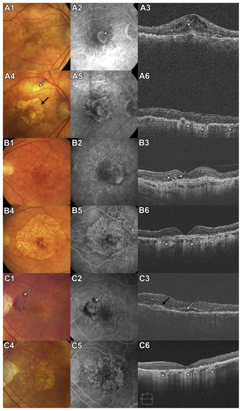 Development Of Geographic Atrophy Ga In Eyes With Neovascular