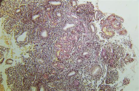 Micropolyps Inflammatory Infiltration S Evere Lymphoplasmacytic Download Scientific Diagram