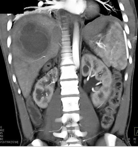 Liver Abscess Gastrointestinal Case Studies Ctisus Ct Scanning