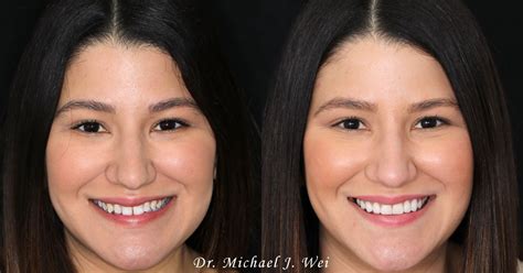 Cosmetic Dentist In Manhattan Perfect Smile Makeovers