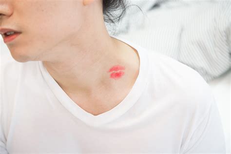 Are Hickeys Bad 4 Facts To Convince You To Avoid The Kiss Of Death