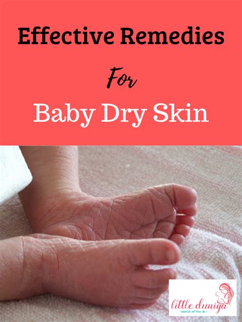 Baby Dry Skin Causes Symptoms And Preventive Measures In 2020 Baby