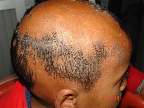 Here Is What You Must Know About Alopecia Areata