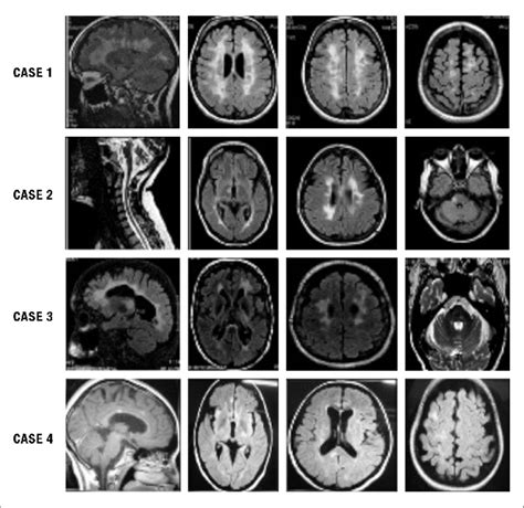 Mri Of The Four Ms Patients Severe Brain Atrophy And Basal Ganglia