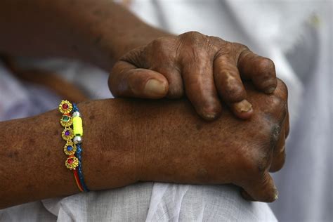India launches biggest leprosy detection campaign to screen 32 crore people - IBTimes India