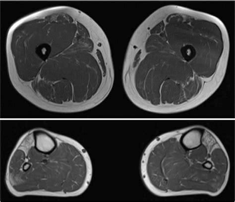 Muscle Mri Of Patient Iv 11 Show Selective Fatty Replacement Of