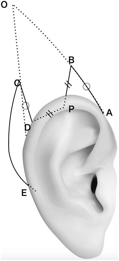 Design Of The Cats Ear Flap Method A The Forefront Of The Crus Of