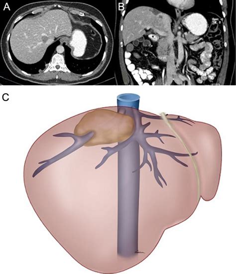 A And B Preoperative Ct Showing Displacement Of The Tumour And Its