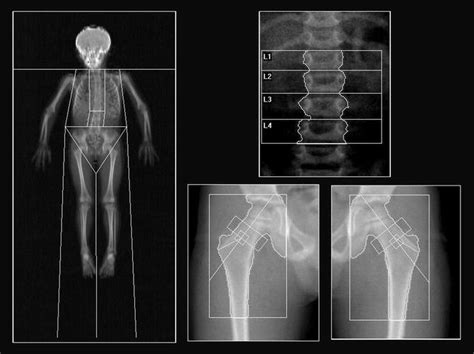 Bone Density Radiology Key