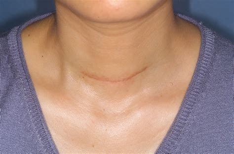 Before And After Pictures Of A Scar From Thyroid Surgery My XXX Hot Girl