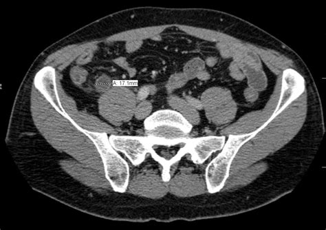 Acute Appendicitis Clinical Features Management Teachmesurgery